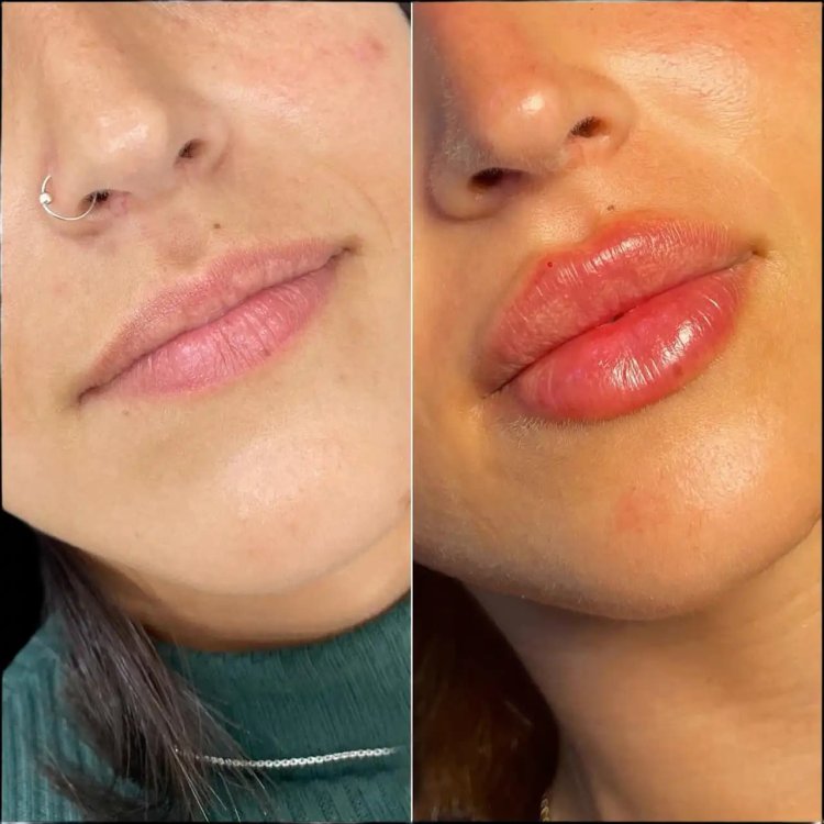 What Makes Lip Fillers Treatments in Dubai Unique?